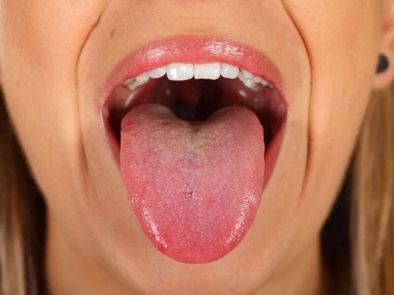 Білий наліт і плями в горлі та мигдаликах